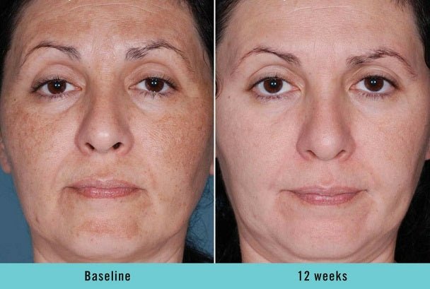 Before-and-after portrait showing clearer complexion at 12 weeks
