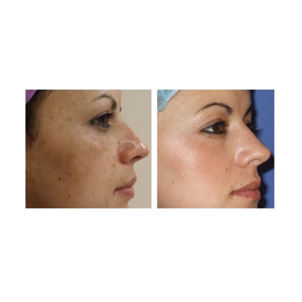 Close-up before-and-after facial skin on a cheek and jawline, left before right after.