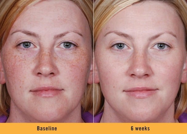 Before-and-after portrait showing clearer skin at 6 weeks