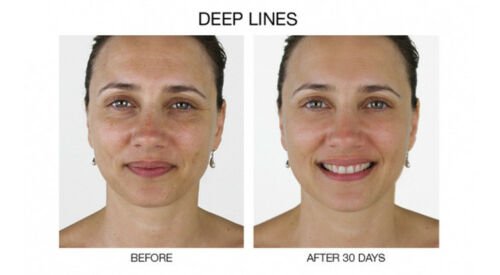 Skin rejuvenation before-and-after headshot pair labeled deep lines