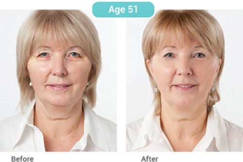 Age 51 before-and-after portrait pair showing smoother skin