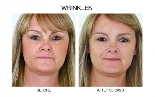 Wrinkles before-and-after face pair labeled after 30 days