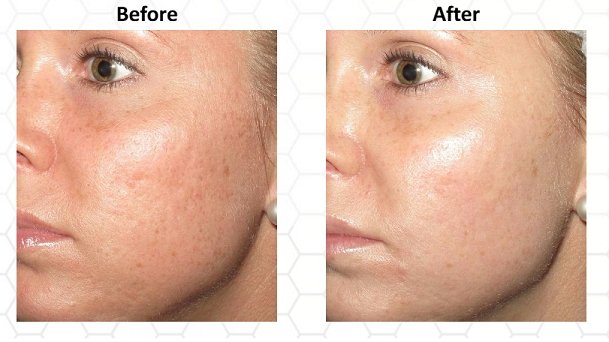 Before-and-after skincare results on face, left before right after