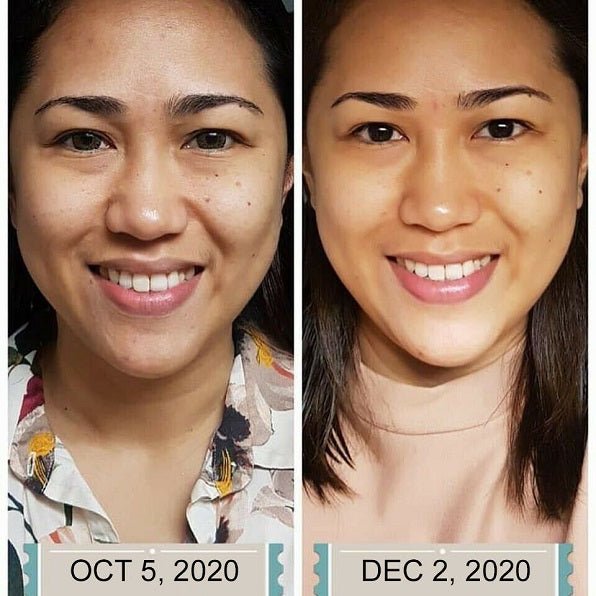 Before-and-after face results with smoother, brighter complexion