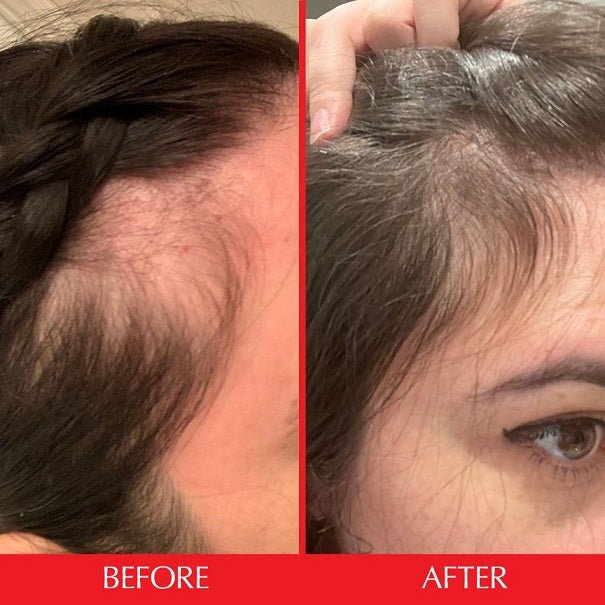 Hair growth before-and-after: smoother scalp and fuller hairline after treatment