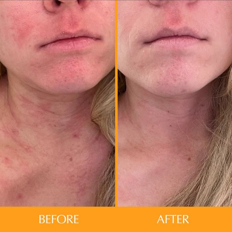 Woman's jaw and neck skincare result, split before and after comparison