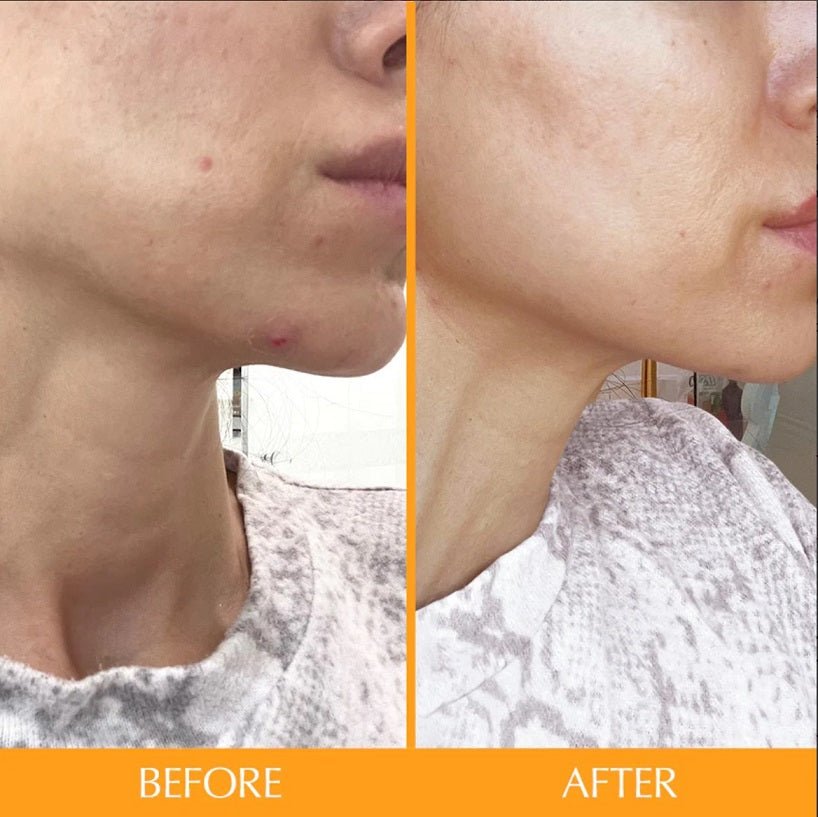 Woman's chin and neck skincare result, split before and after comparison