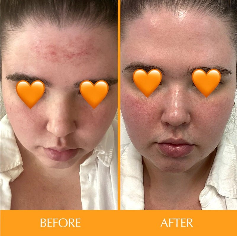 Woman's under-eye skincare result with heart stickers, split before and after