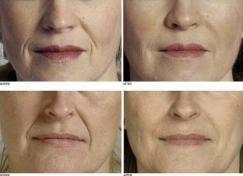 Four-panel closeup face showing gel cream results, before use and after use