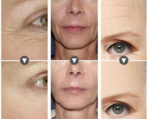 Closeup collage of facial areas showing gel cream results before use and after use