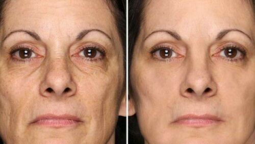 Hyaluronic acid + Matrixyl 3000 serum front face skin before/after