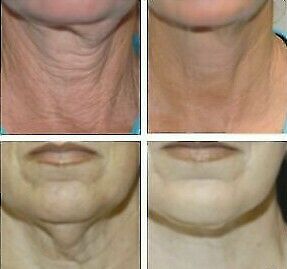 Hyaluronic acid + Matrixyl 3000 serum chin and neck skin before/after