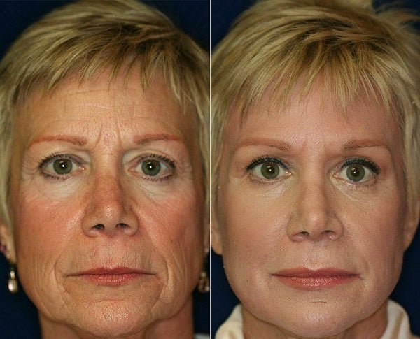 Hyaluronic acid + Matrixyl 3000 serum full face skin before/after