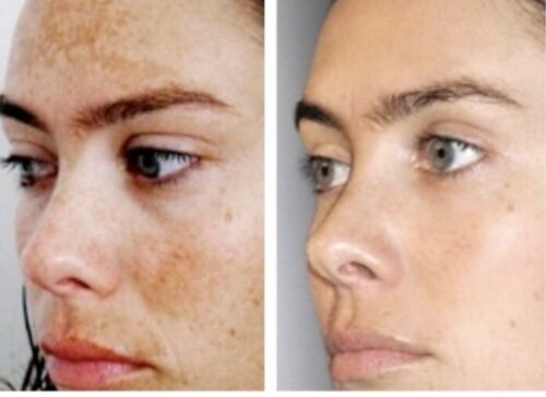 Side-by-side portraits of face skin showing freckles and uneven tone