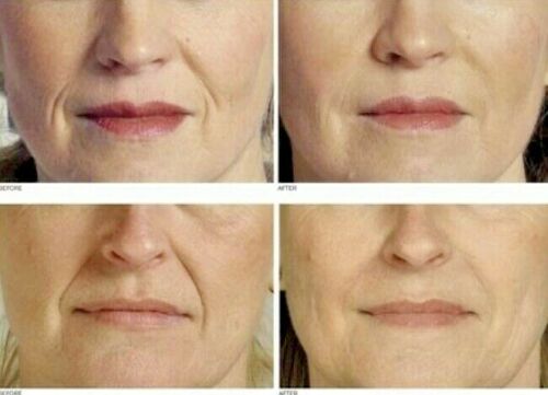 Retinol serum skincare results: close-up face panels showing cheeks and lips