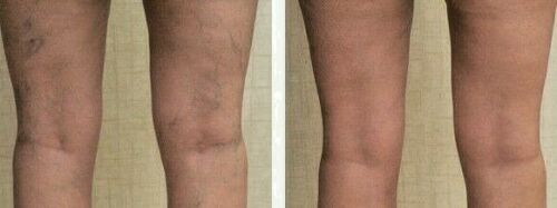 Before-and-after view of legs with reduced-looking redness on lower legs