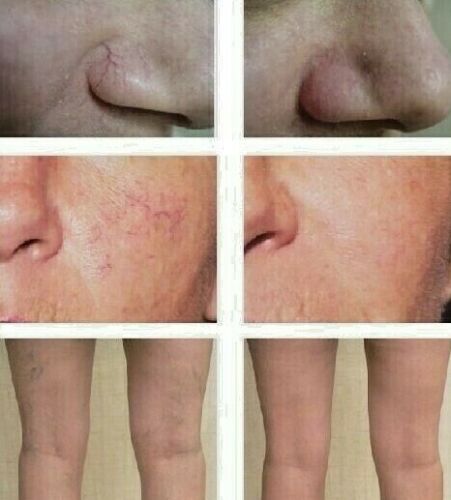 Legs with visible skin discoloration and vein-like redness on lower legs