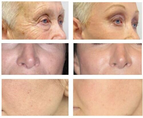 SkinBum anti-wrinkle serum facial results with four close-up panels of skin