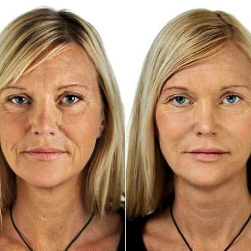 Anti-aging gel cream results on face, smoother skin and reduced wrinkles