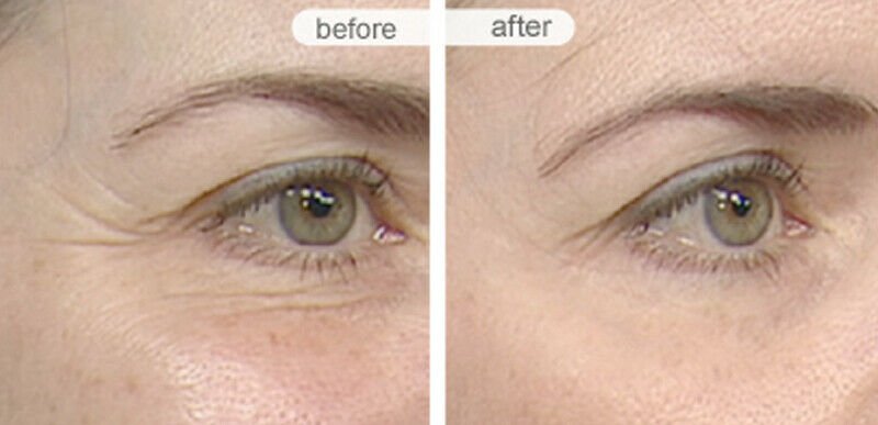 Anti-aging gel cream eye-area results with smoother skin around the eye