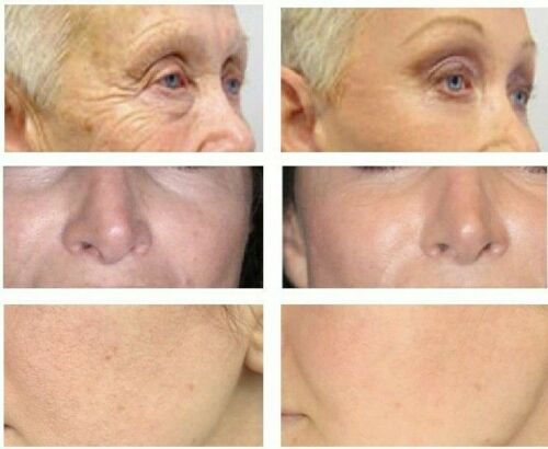 Anti-aging gel cream skin results shown on cheeks, nose, and chin areas