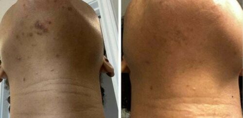 Two close-up skin photos showing dark spots on chest/neck area