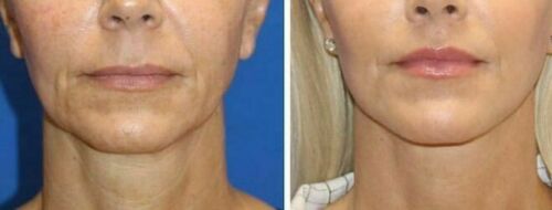 Side-by-side close-ups of lower face and smile lines with skin texture differences
