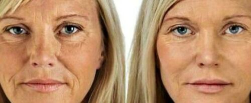 Side-by-side face close-ups with smoothness differences in forehead and cheeks
