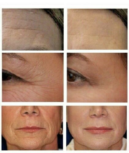 Set of facial close-ups with visible forehead wrinkles, side-by-side skin detail views