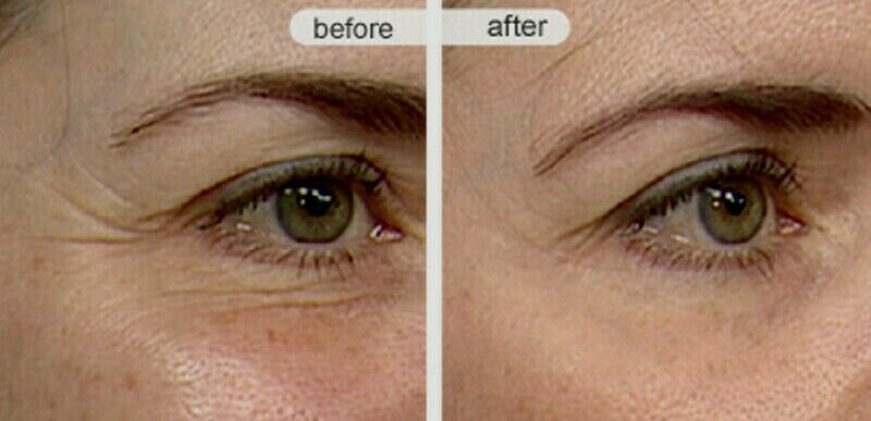 Eye area close-ups labeled before and after, showing under-eye skin texture
