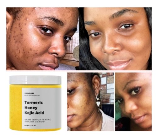 Turmeric honey kojic acid sugar scrub jar, shown with skin before-after collage