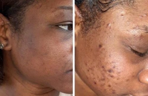 Close-up before-and-after skin texture with turmeric honey kojic acid sugar scrub