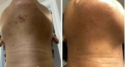 Skin tone comparison of upper body showing reduced dark spots