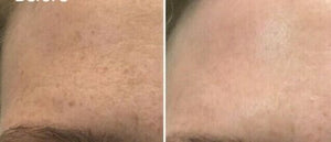 skinbum-sun-spot-age-spot-removal-cream-bodytonix-australia