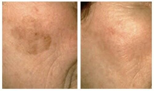 SkinBum Sun Spot / Age Spot Removal Cream - bodytonix