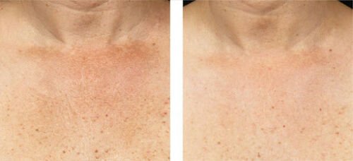 Close-up skin comparison with lighter tone and fewer sun spots across cheek