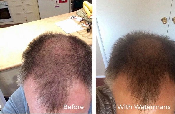 Watermans hair growth treatment results: top-of-head before and after thinning hair