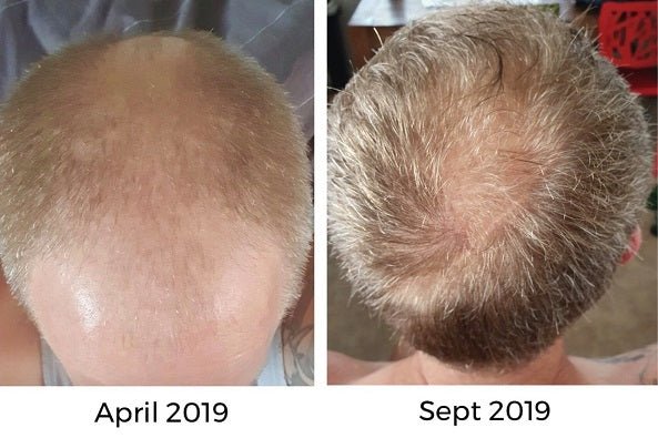 Watermans hair growth treatment results: close-up scalp photo with hair density over time