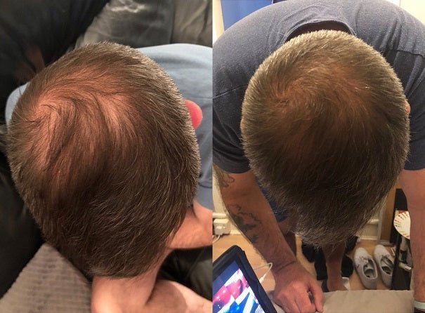 Watermans hair growth treatment results: close-up of a man’s scalp and hairline from behind