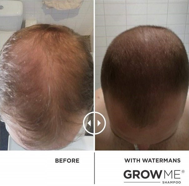 Watermans hair growth treatment results: split back-of-head scalp photo showing fuller coverage